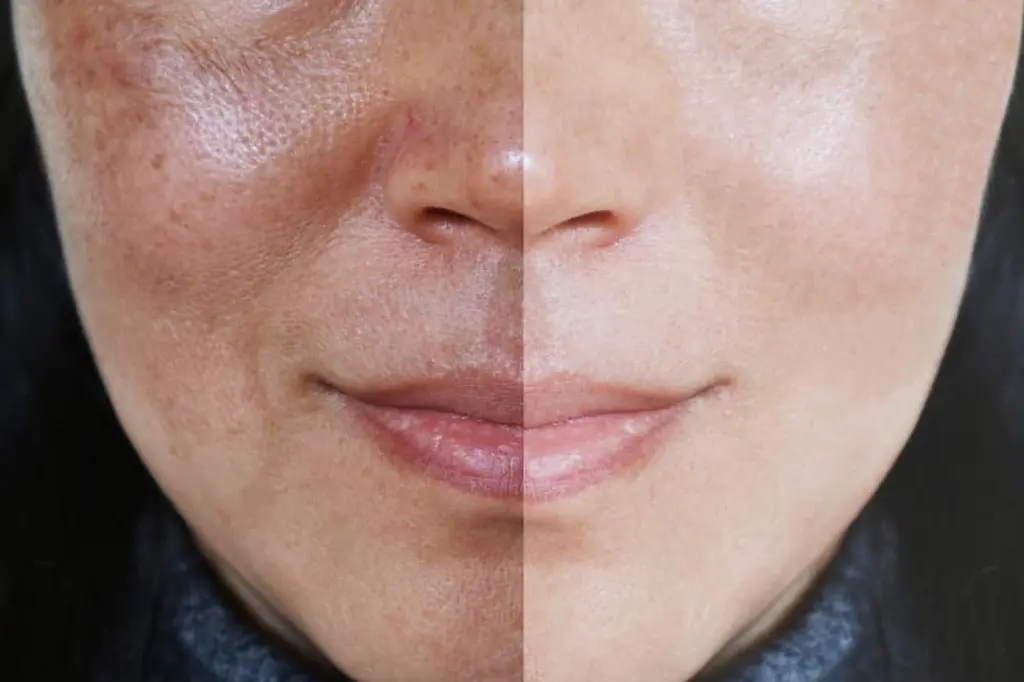 নাছোড়বান্দা মেছতা দূর করার সহজ উপায় 6 melasma 3